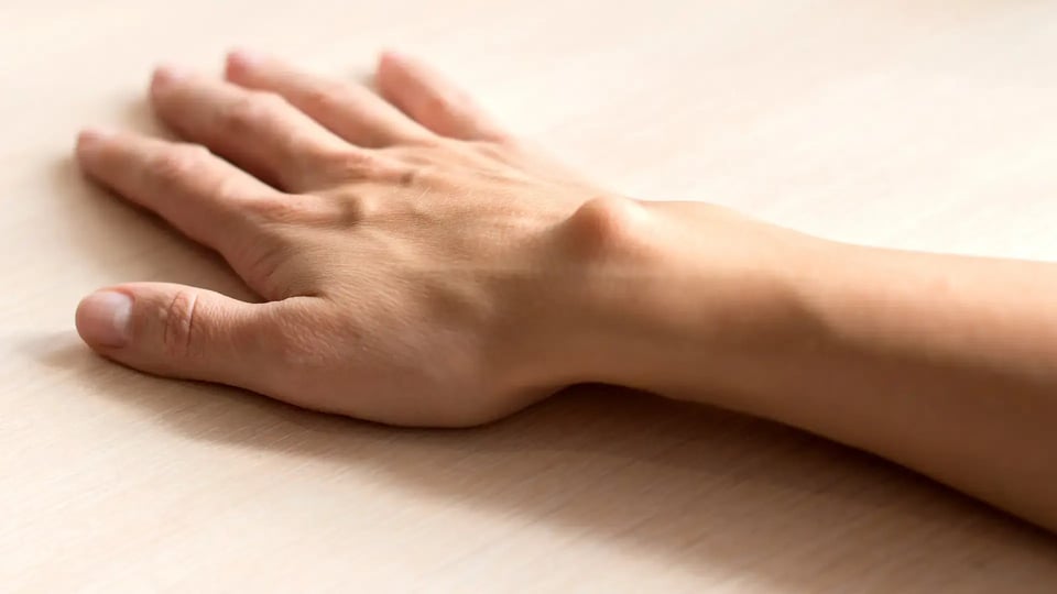 Female hand with a hygroma. Pain. Wrist ganglion cyst