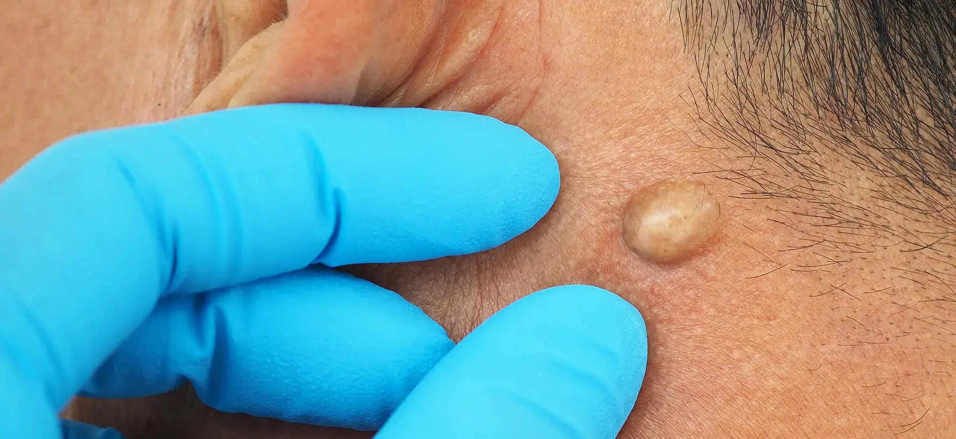 PSN - Cysts (T3) - banner