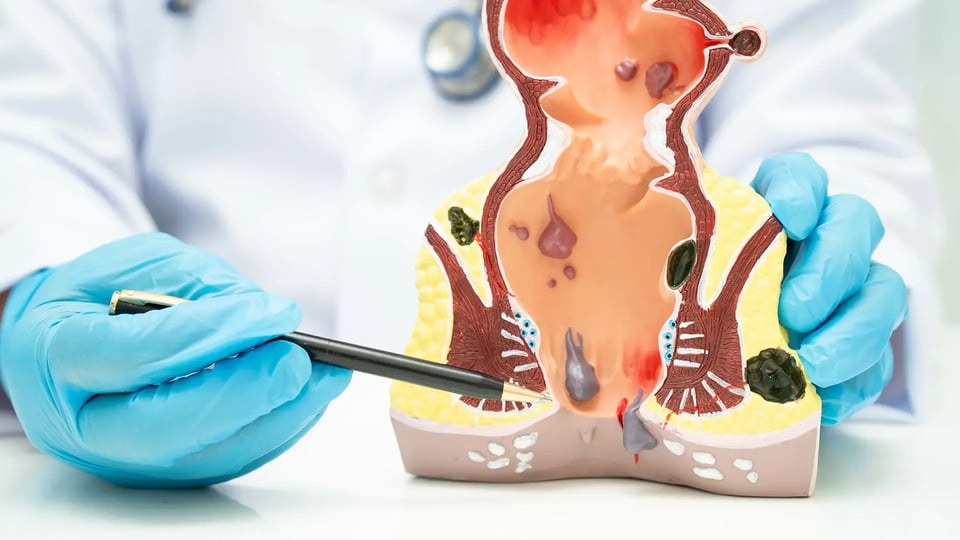 doctor with rectum and hemorrhoid human anatomy model at hospital, inflamed vascular structure_