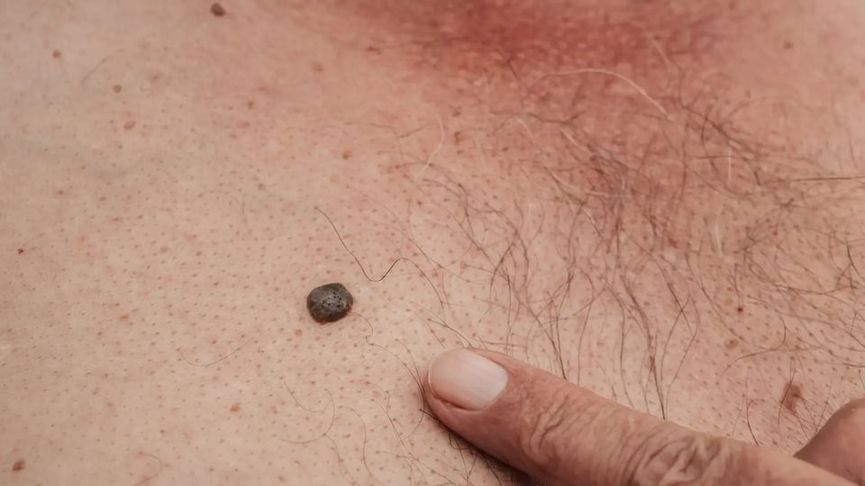 keratinizing squamous cell carcinoma of the skin of an elderly man
